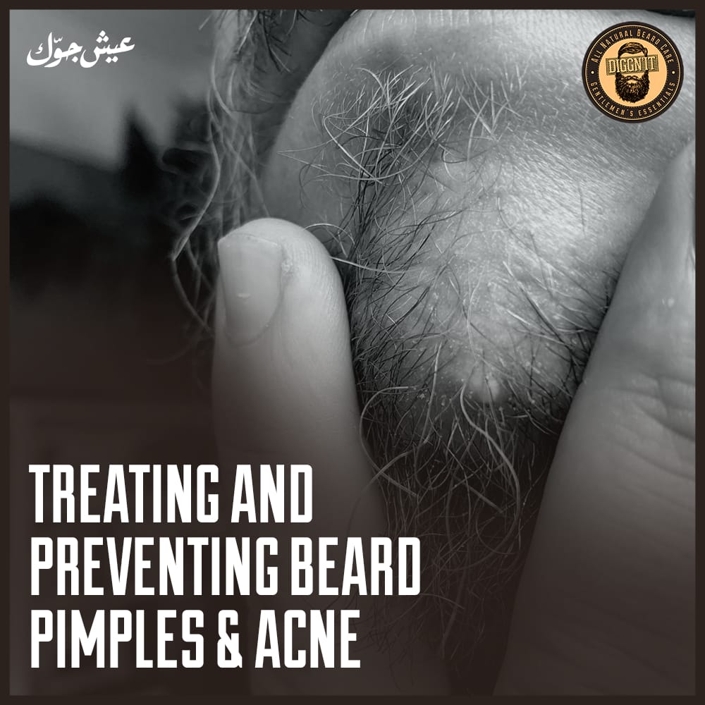 Treating and Preventing Beard Pimples & Acne